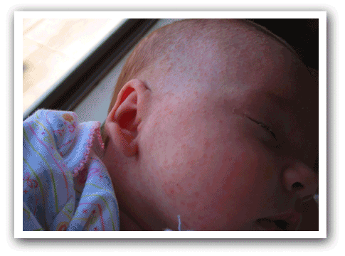 heat rashes in babies. Heat rash?